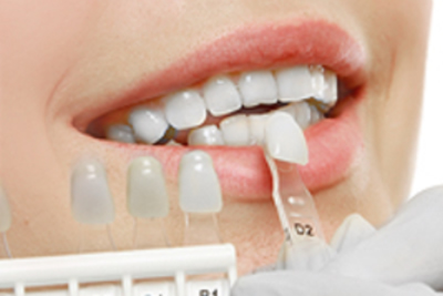 Veneers