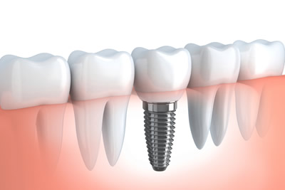 Implants