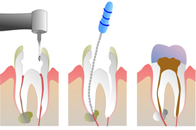 Root Canal