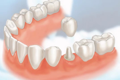 Dental crowns and implant model