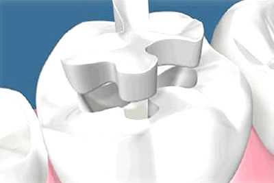 Porcelain Fillings